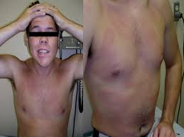 A Comprehensive Overview of Lyme Disease