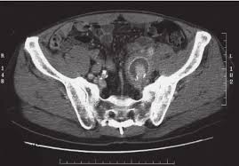 A Comprehensive Overview of Aneurysms: Causes and Care