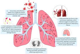 Understanding Bacterial Pneumonia: Causes, Symptoms, and Treatments