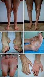 Understanding Charcot Marie Tooth Disease and Its Impact
