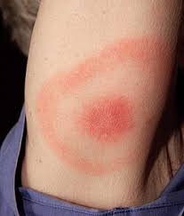 Understanding Lyme Disease: Symptoms, Causes, and Prevention