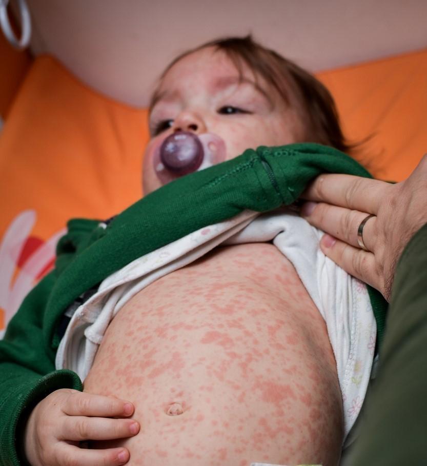 Understanding the Current State of Measles Outbreaks