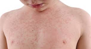 Understanding Measles: A Public Health Concern in 2023
