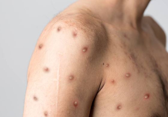 Monkeypox: What You Need to Know in 2023