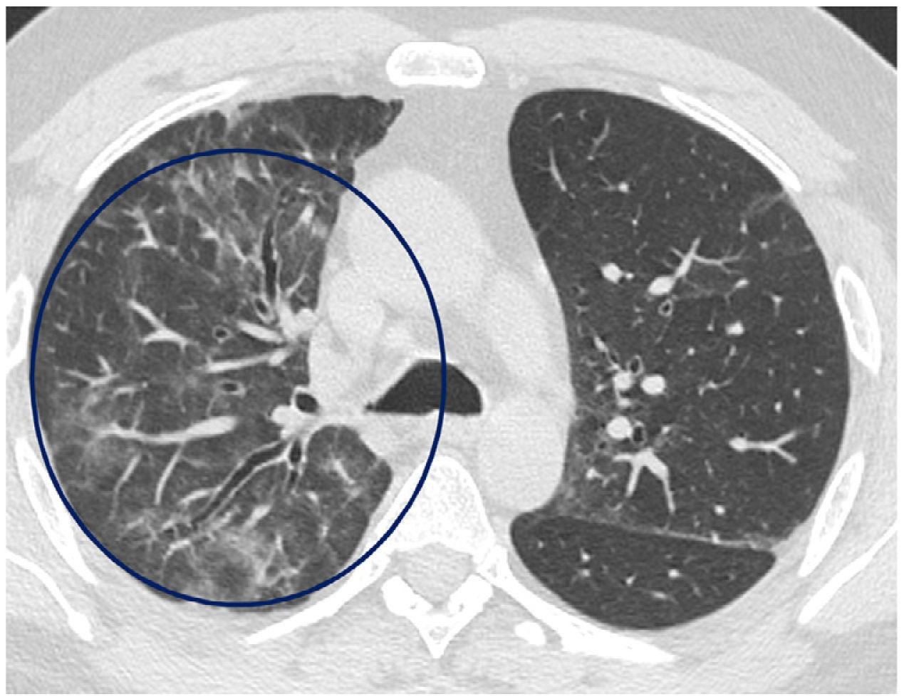Pneumonia: Causes, Symptoms, and Treatment Approaches