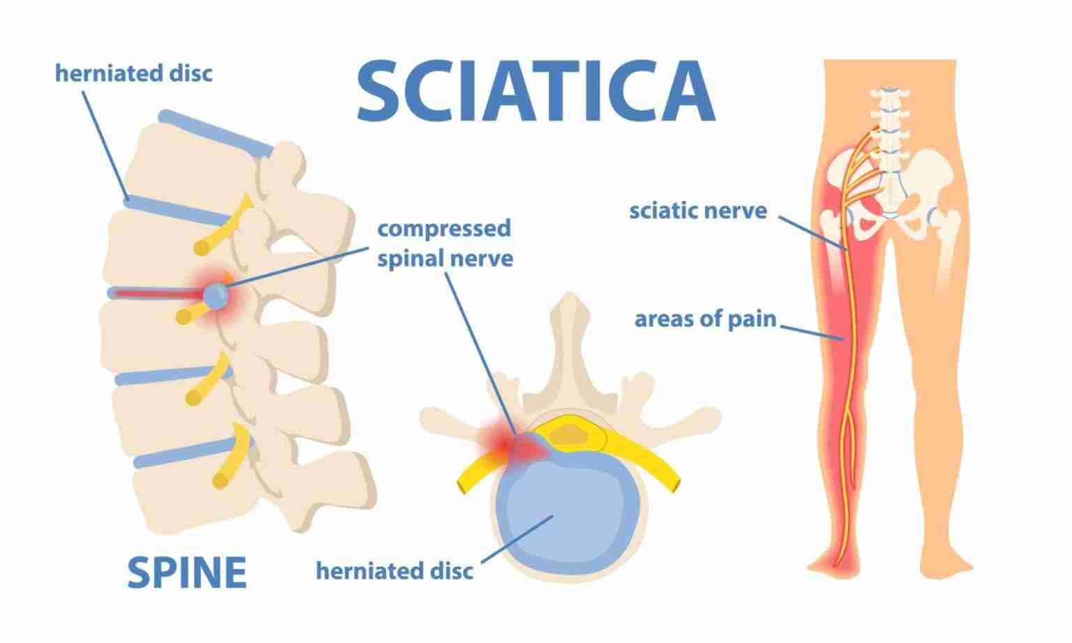 A Comprehensive Guide to Sciatica: Symptoms and Remedies
