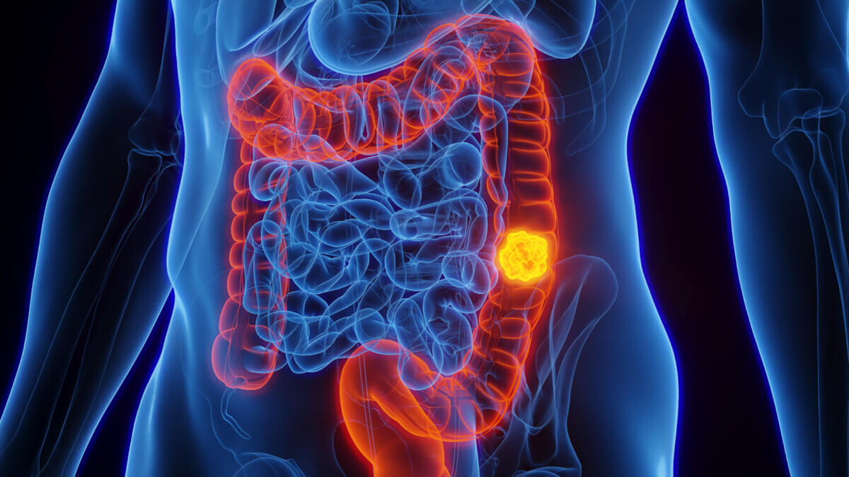 Understanding Colorectal Cancer: Symptoms and Prevention