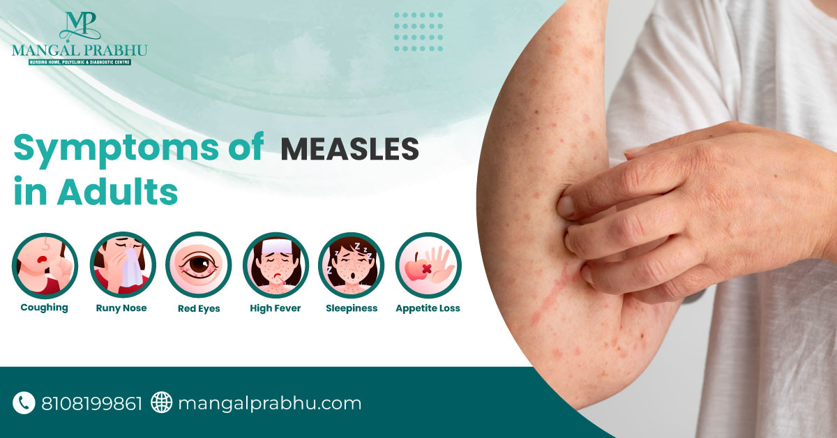 Recognizing the Symptoms of Measles: A Vital Health Guide