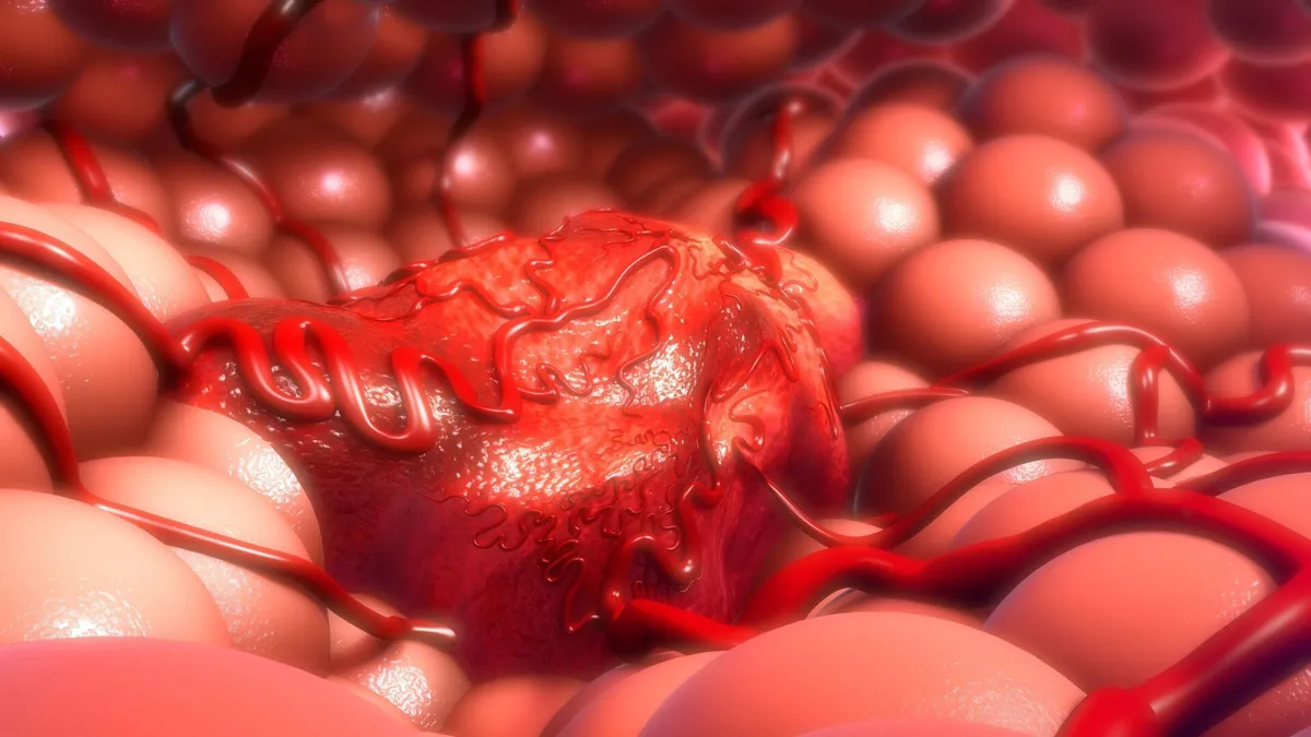 cancer colorectal — CA news